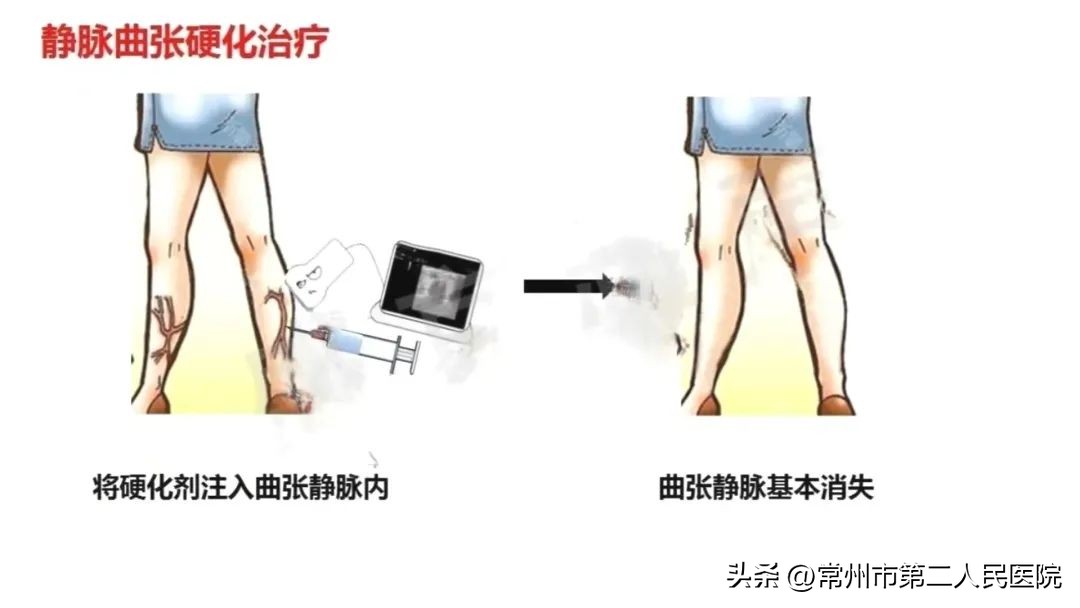 小针孔，用途多，漫画带你了解介入超声能做啥？