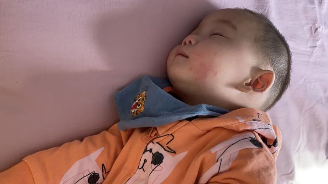 打八月龄的麻腮风注意什么,八月龄的麻腮风可以不打吗