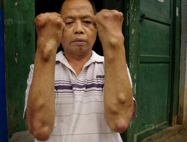 水银温度计打碎了被孩子误食,孩子误食温度计水银会有什么后果