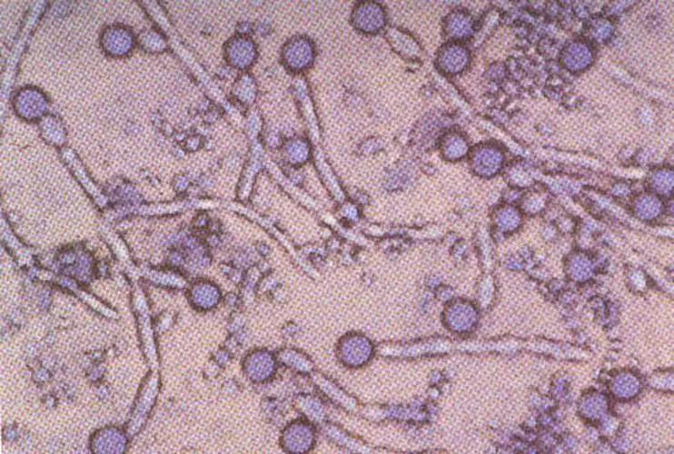 皮肤念珠菌病是什么症状,皮肤念珠菌病传染吗