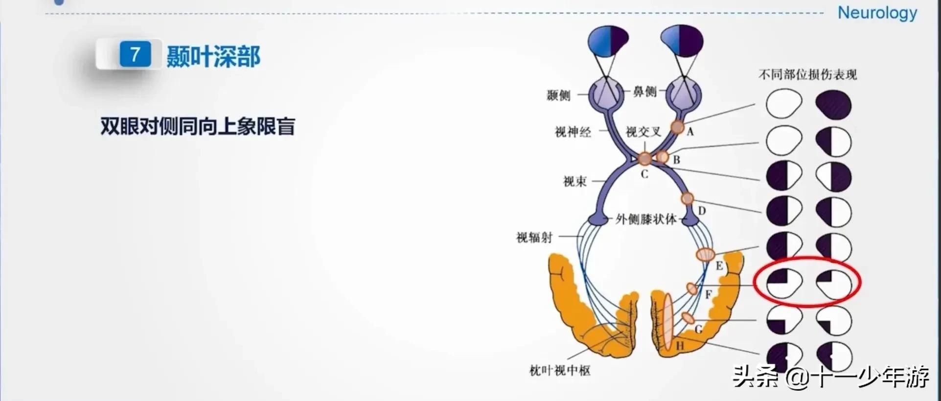 大脑的结构解剖示意图,大脑镰下疝解剖结构
