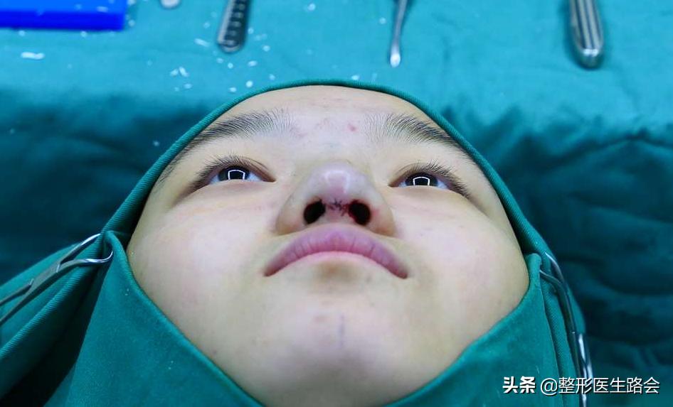 全脸整形记录恢复过程,女孩整形全过程