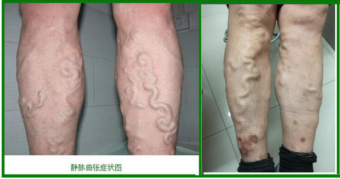 缓解静脉曲张简单实用不花冤枉钱,精索静脉曲张吃药能缓解疼痛吗