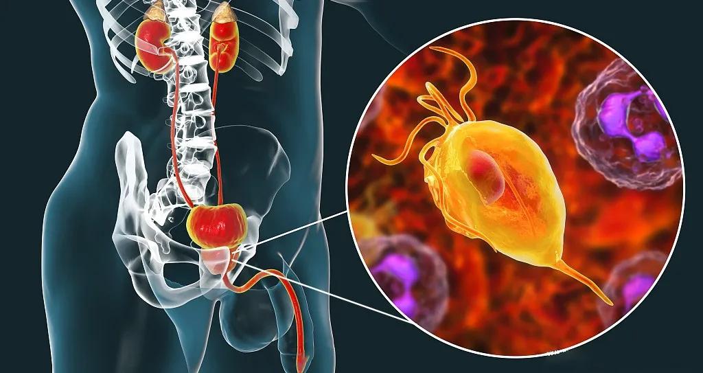 前“腺”危机—您的前列腺炎为何这么难治?