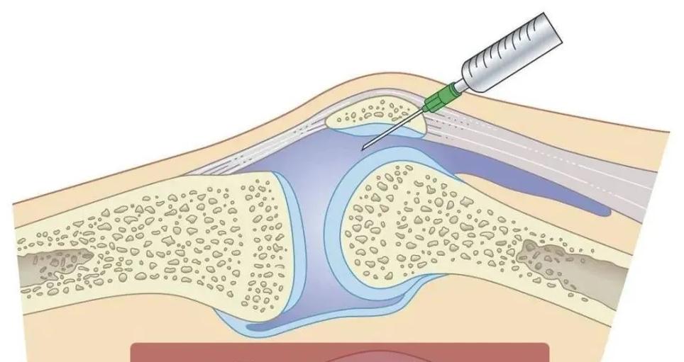 关节prp治疗要打麻药吗,风湿性关节炎prp