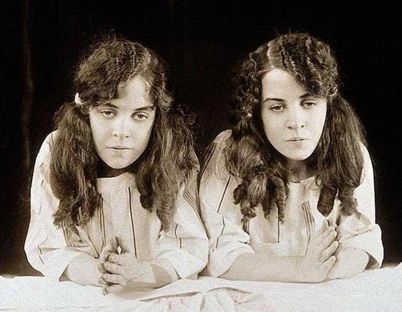 英国连体姐妹分离手术大结局,英国连体姐妹姐姐死后怎样