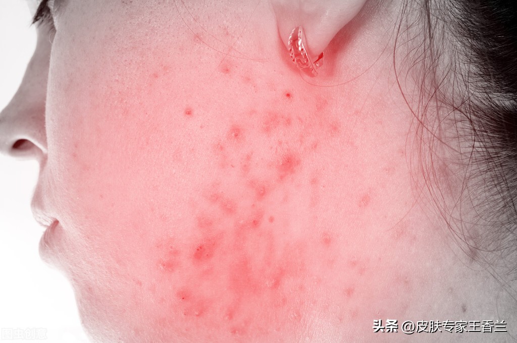 皮肤出油毛孔粗大起痘痘怎么回事,多油毛孔粗大皮肤粗糙容易长痘痘