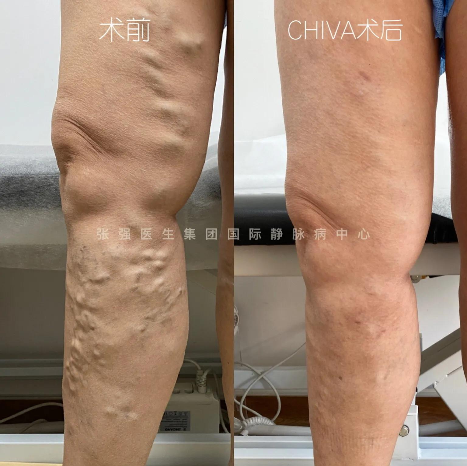 臭氧治疗静脉曲张好不好,臭氧疗法治疗静脉曲张效果怎么样