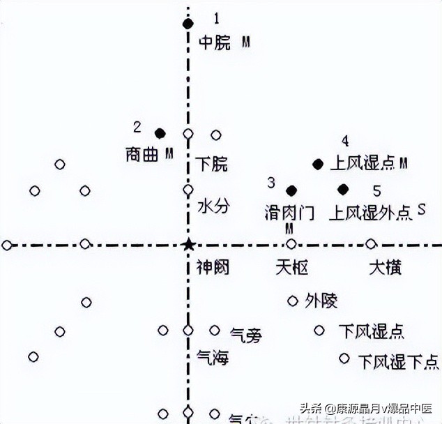 腹针疗法及16例常用处方