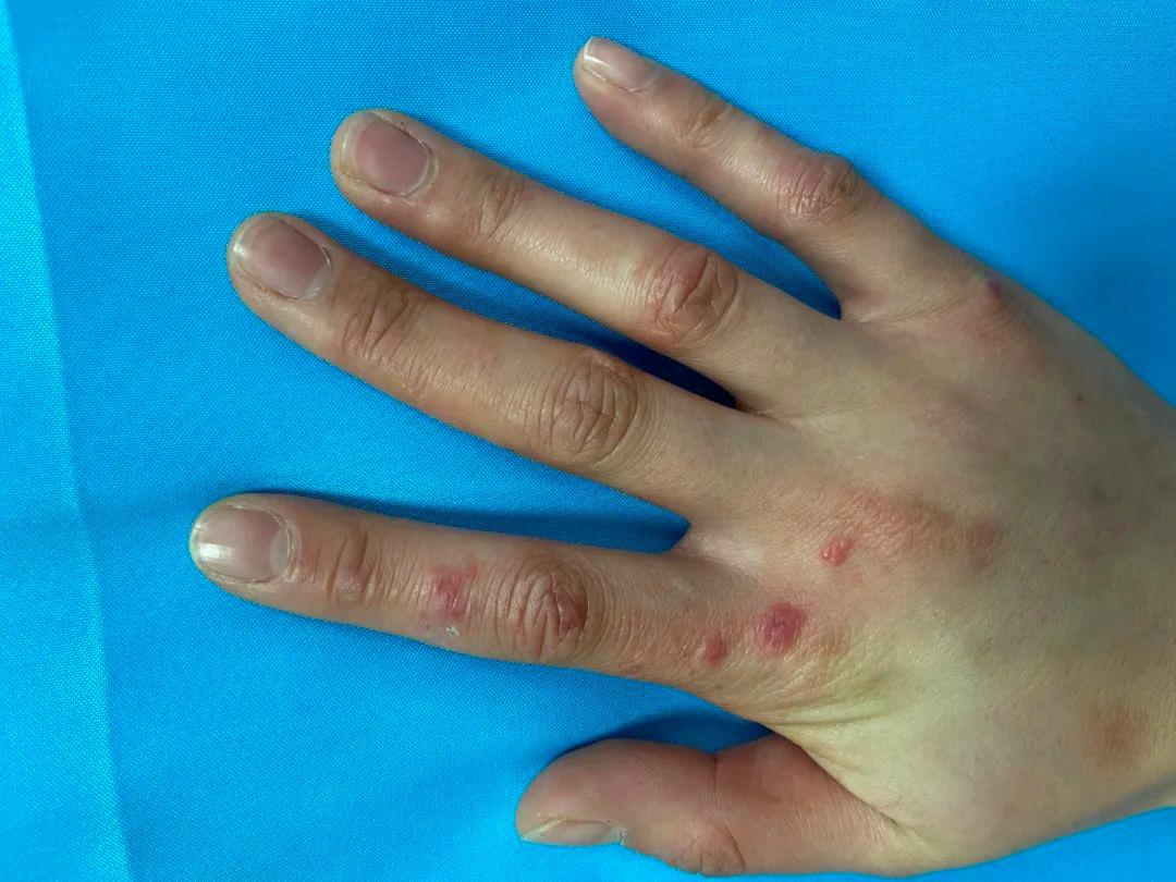 冬天手冻疮夏天怎么治,皮肤病冻疮怎么引起的