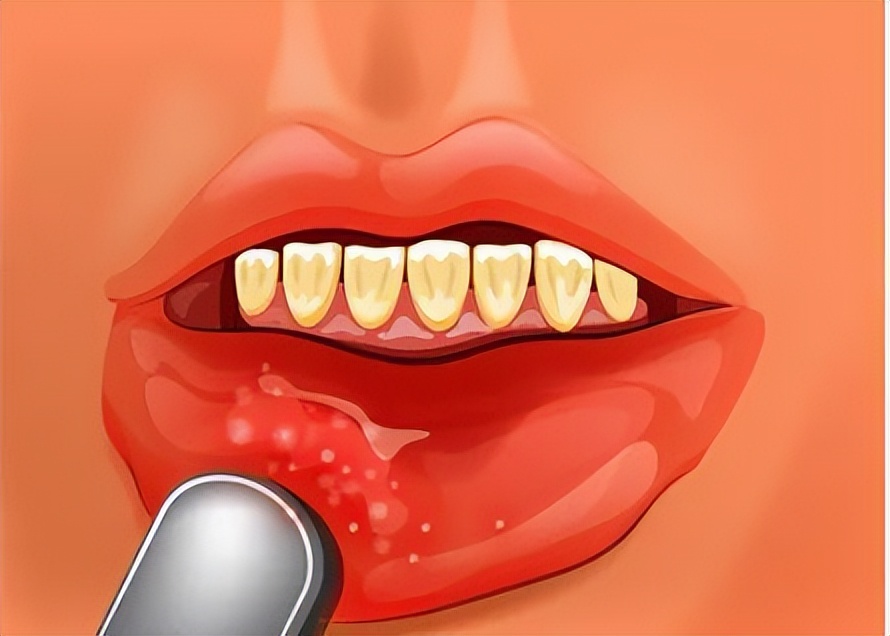口腔癌早期的5个危险信号,口腔癌早期5大症状及表现