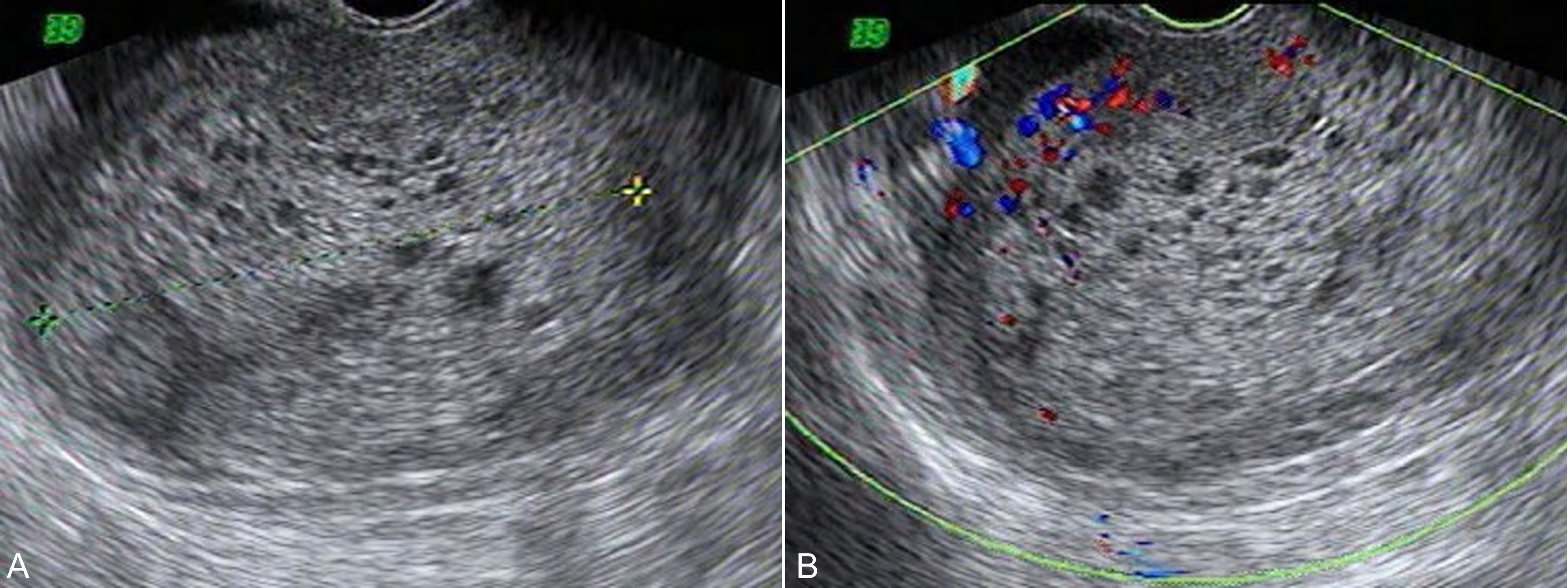 明明白白做b超,妊娠滋养细胞疾病超声报告
