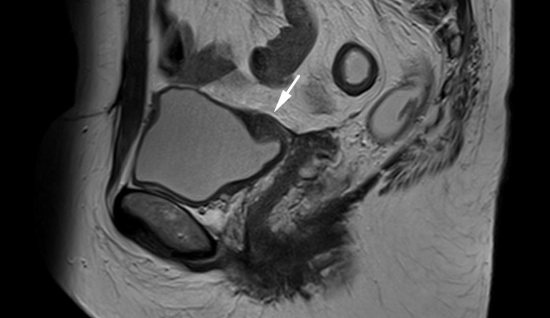 MRI如何评估子宫内膜异位症？这10个病例会帮助您