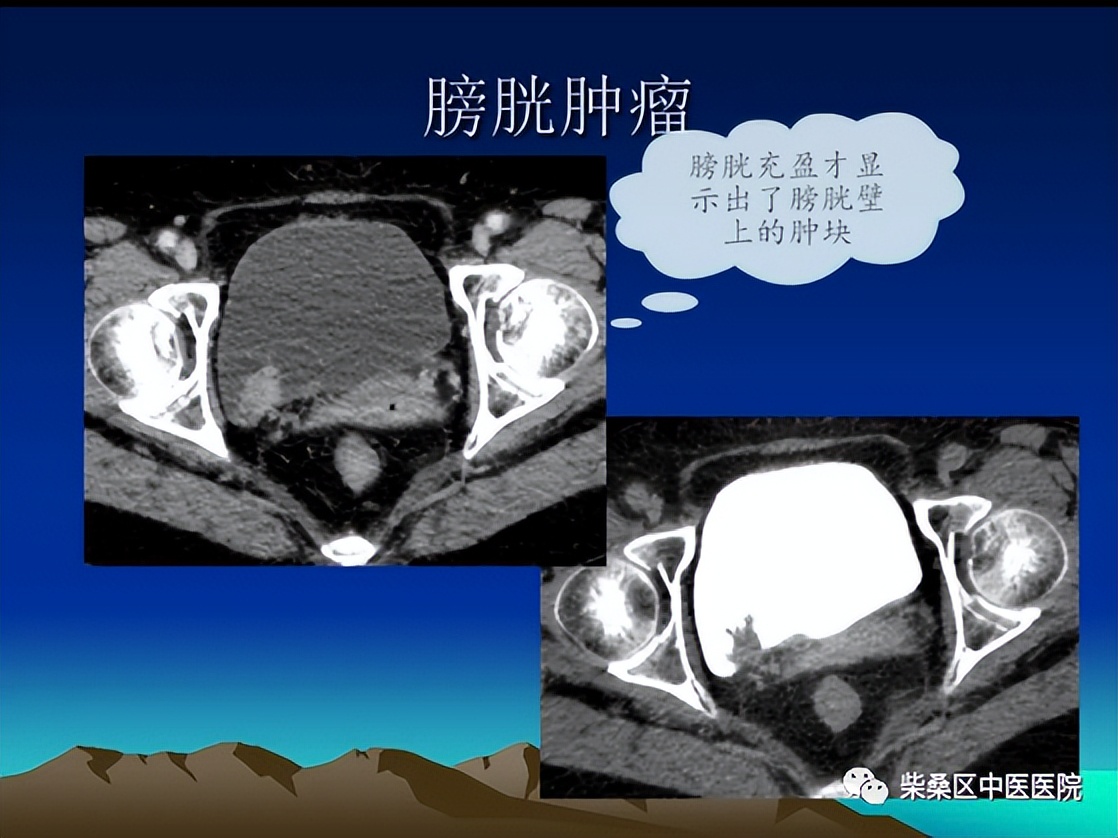 做ct喝水憋尿要多久,喝水憋尿做的尿常规准确吗