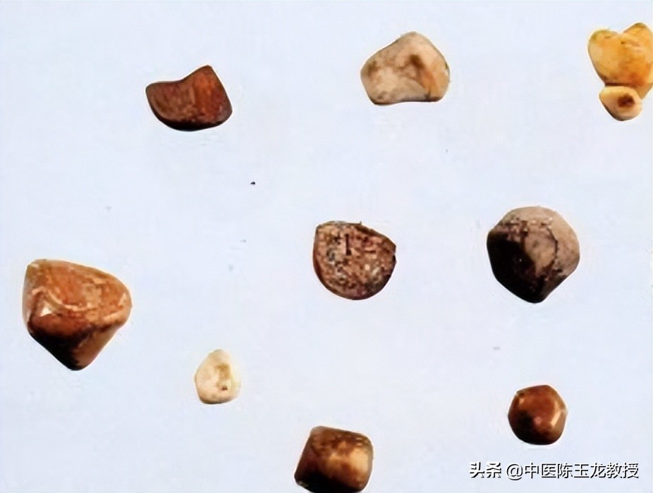 中医治疗膀胱结石经典处方,治疗胆结石肾结石膀胱结石的方子