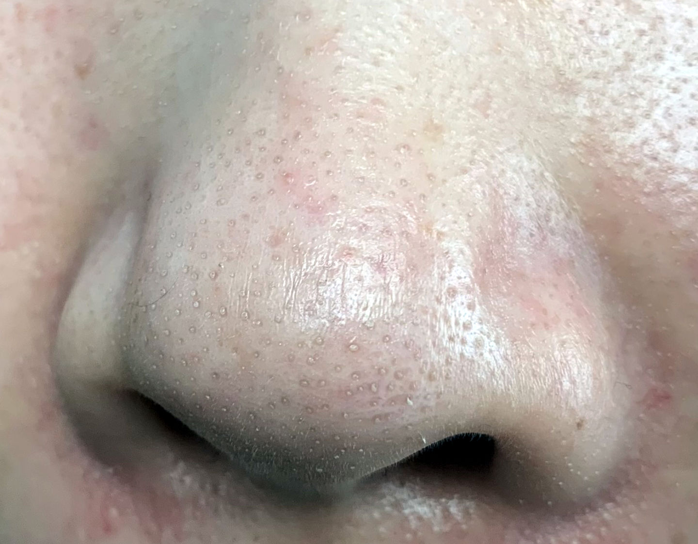 为什么鼻子可以挤出很大的黑头,用夹子挤出鼻子黑头