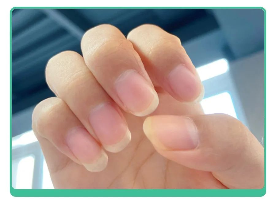 小孩指甲凹陷变黑有坑是什么原因,小孩指甲有白点和细纹是怎么回事