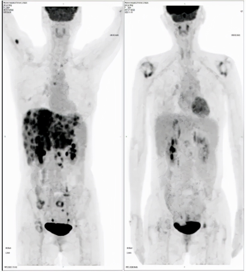 病例实录|免疫联合方案治疗胰腺癌多发转移的病例分享