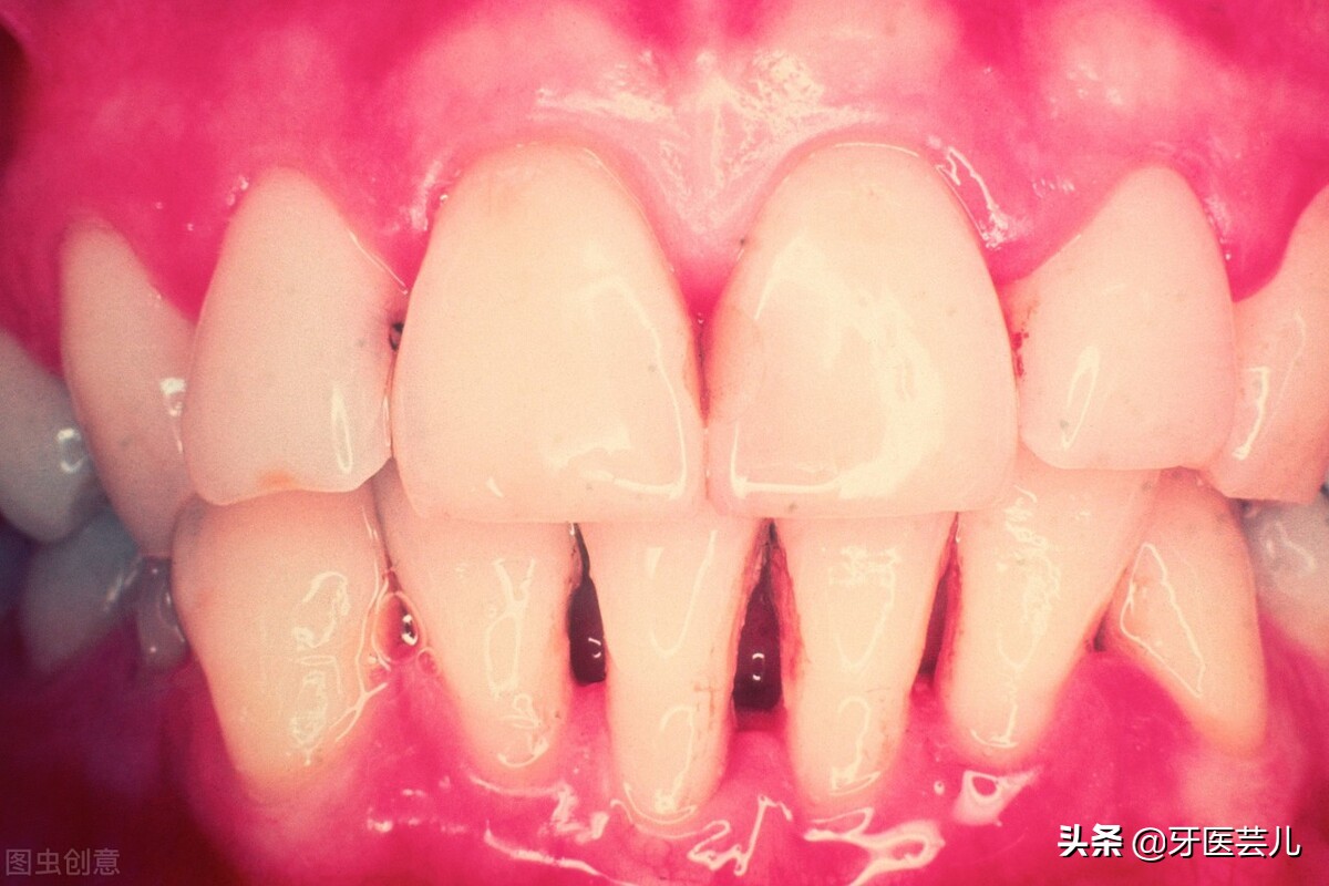 牙龈出血是找牙医还是找医生,牙龈出血是什么原因怎么治疗最快