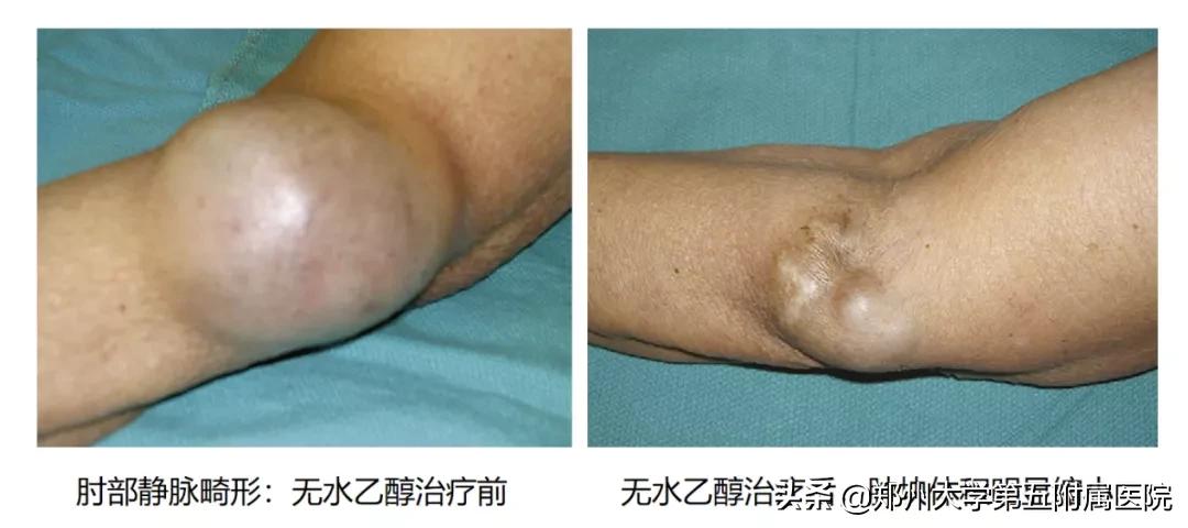 健康科普治疗结节,静脉畸形有硬肿块要做手术吗