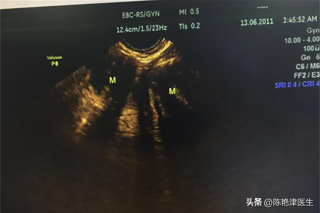 女性为什么容易长子宫肌瘤?提醒:平时尽量避免3个行为,别忽视