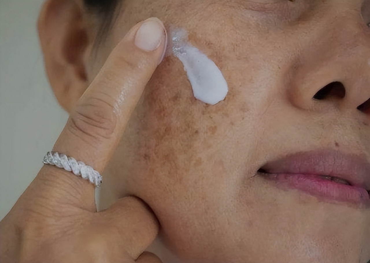 红霉素软膏的淡斑方法小妙招,2元钱的红霉素软膏能治疗什么病