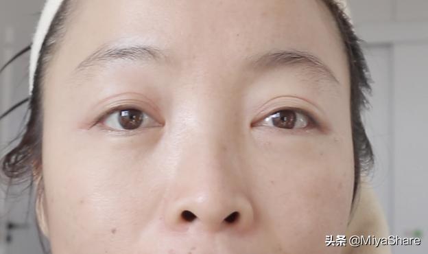 拖了一年的手术,眼袋手术5年后的感受