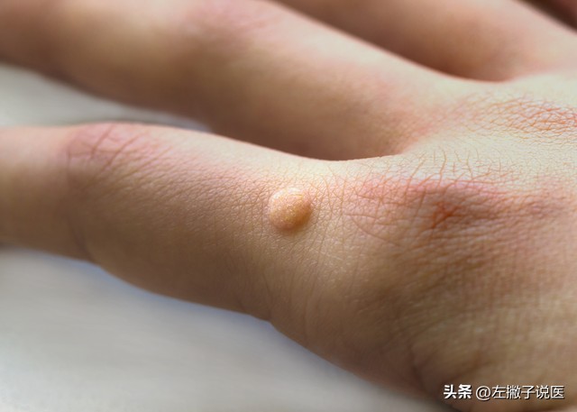 脖子上的“小肉球”是怎么一回事？可以用手抠掉吗？告诉你答案