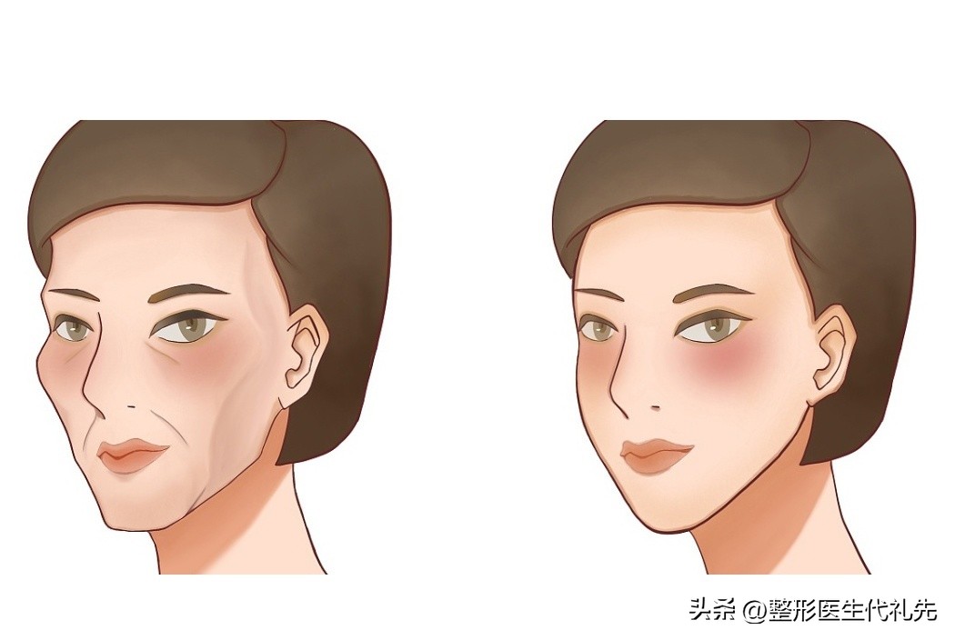 脸颊凹陷怎么改善最有效的方法,面颊衰老凹陷怎么改善