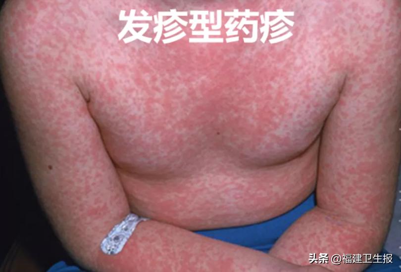 阳了后浑身痒、起疹子？医生提醒：分清类型再治疗