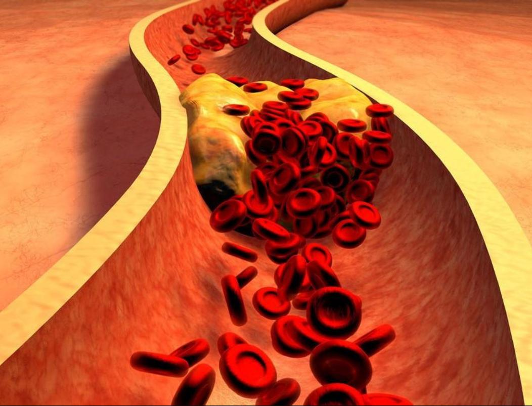颈动脉硬化有斑块要吃阿司匹林吗,发现颈动脉斑块必须吃药吗