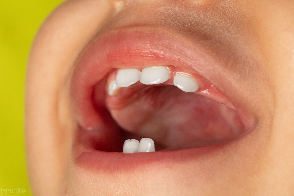 牙齿与牙齿之间空隙大怎么办,牙齿与牙齿之间有空隙
