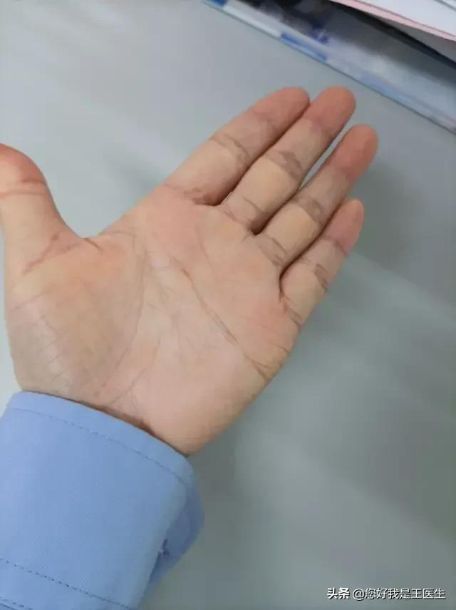 手指怎么测可以看出有没有得脑梗,手诊看掌纹