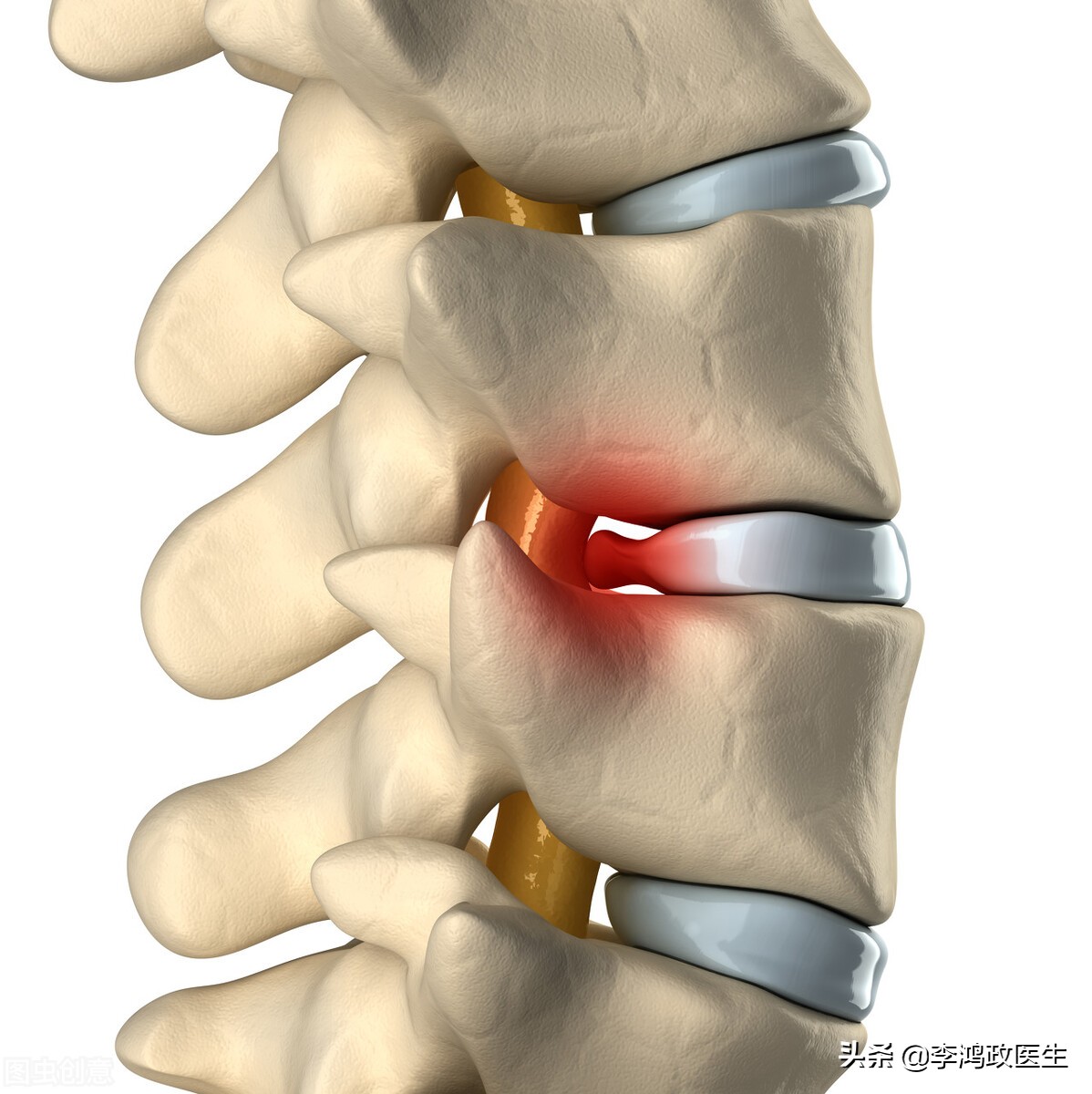 腰间盘突出有没有可能误诊,女子腰痛误诊腰椎间盘突出