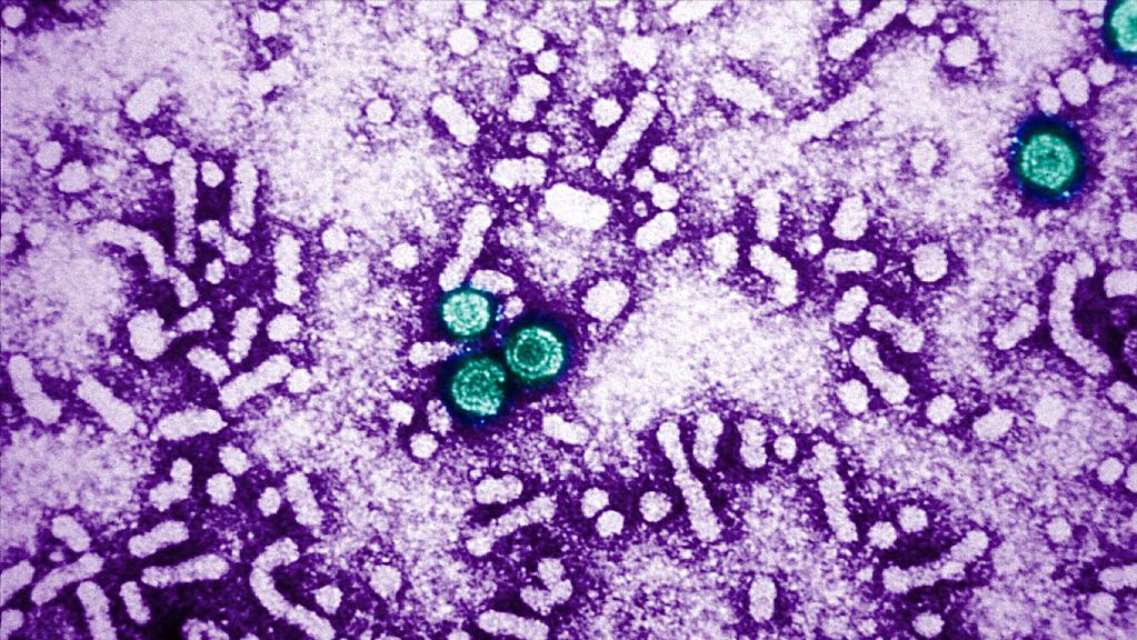 体检总胆红素偏高是肝病吗,肝病患者胆红素升高说明什么