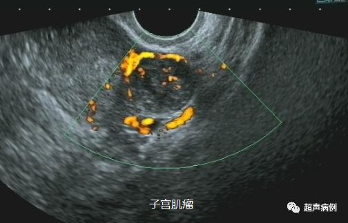 做阴道B超是一种什么样的体验？