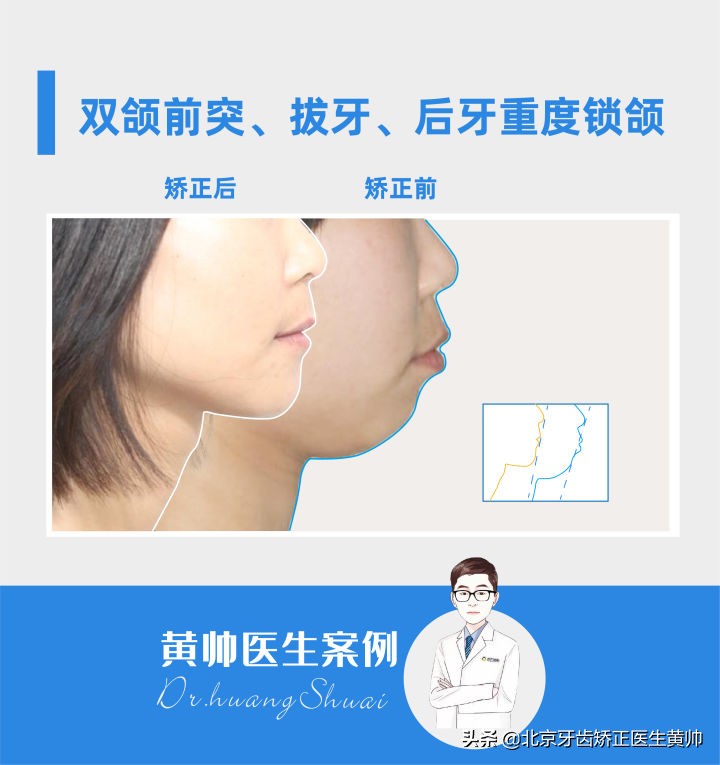 嘴凸的人怎么笑起来好看,嘴凸怎么让自己不焦虑