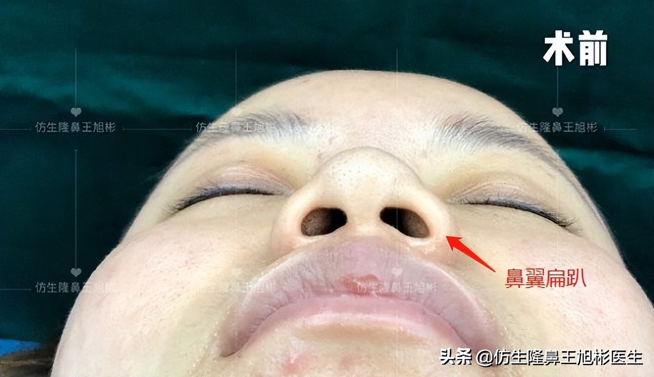 鼻头部位整形,鼻头圆钝高鼻梁整形案例