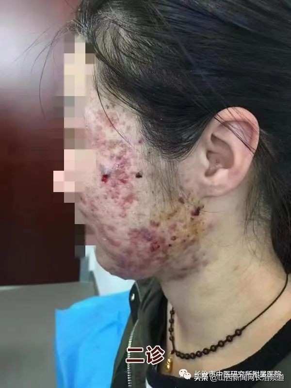 长治市中医研究所附属医院皮肤科用“火针+中药+倒模”疗法成功治疗一例中重度*疮痤**患者