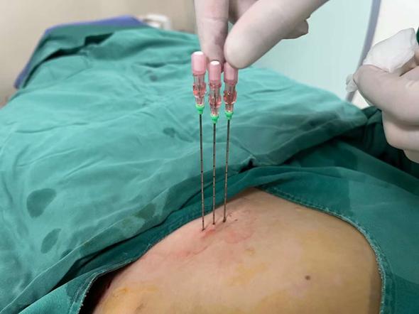 宫颈癌淋巴结转移中医治疗,宫颈癌盆腔淋巴结转移治疗方案