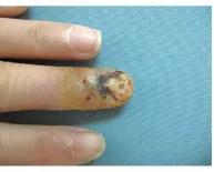 指甲出现黑线是什么病,指甲出现黑线怎么治疗