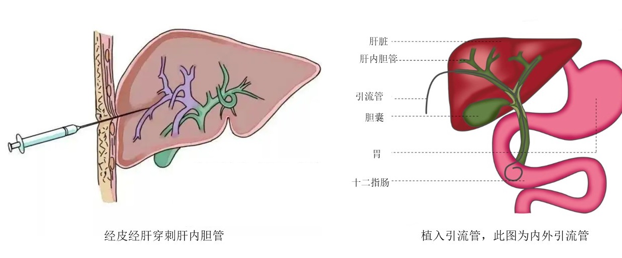 带着引流管可以坐飞机吗,胆道外引流最新消息