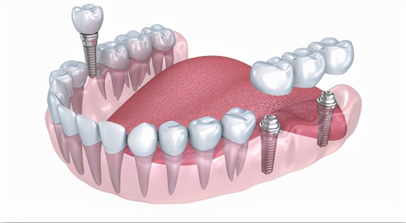 老人假牙的种类及价格,假牙的种类及价格你知道吗