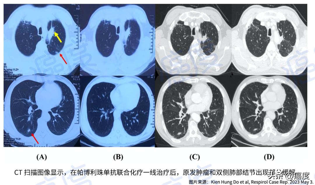 肺癌靶向耐药后可以用pd1吗,没靶向药没pdl1怎么治肺癌