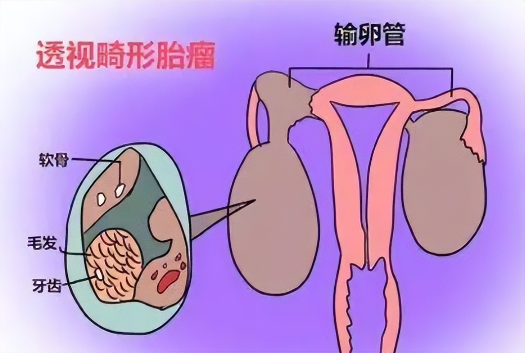 子宫内发现毛发是什么原因,女子体检检查出肌瘤