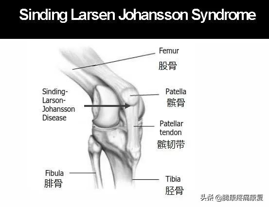 消除膝关节疼痛的方法,怎样消除膝关节响声