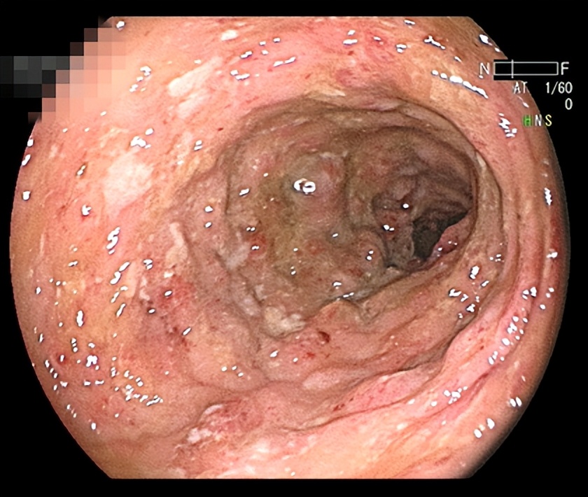 20多岁年轻姑娘，她的肠道竟然是这样的……