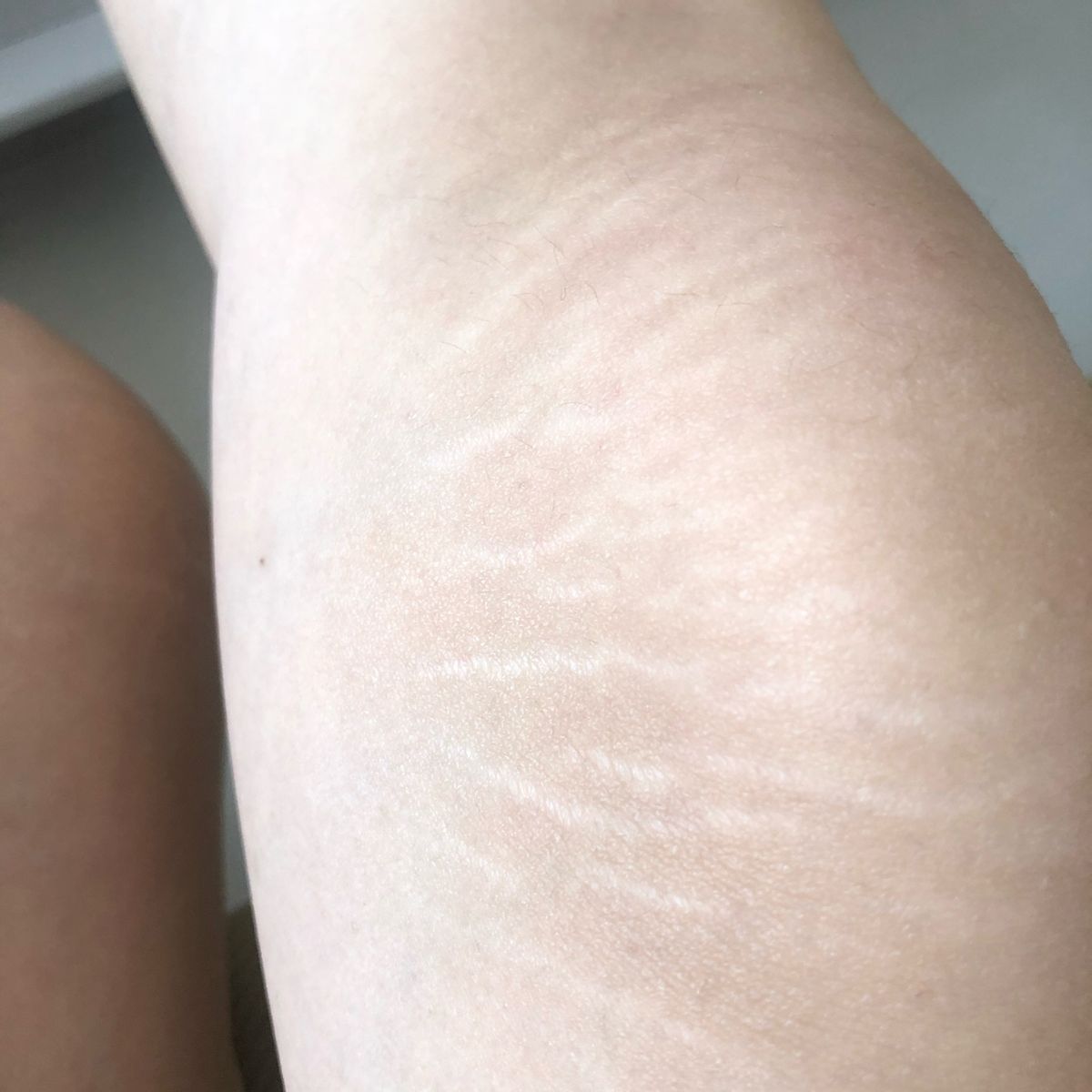 如何淡化腿上肥胖纹小窍门,腿上有肥胖纹怎么遮瑕