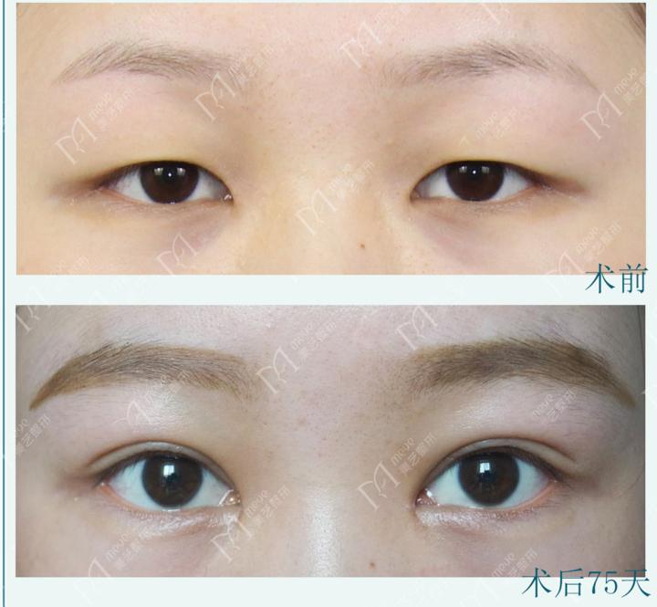 单眼皮肿眼泡消肿后能变成内双吗,单眼皮肿眼泡眼睛还能变好看吗