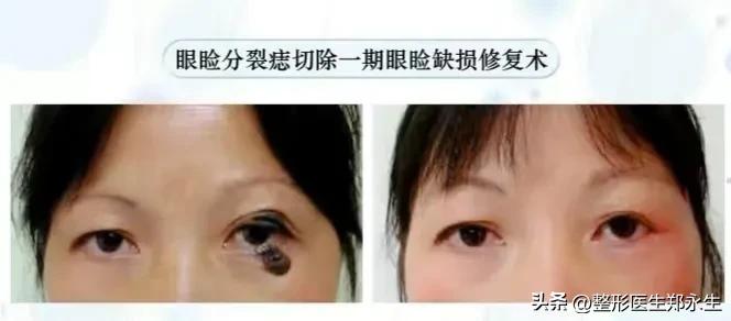 长在眼睛上的肿瘤,长在眼睛周围的痣